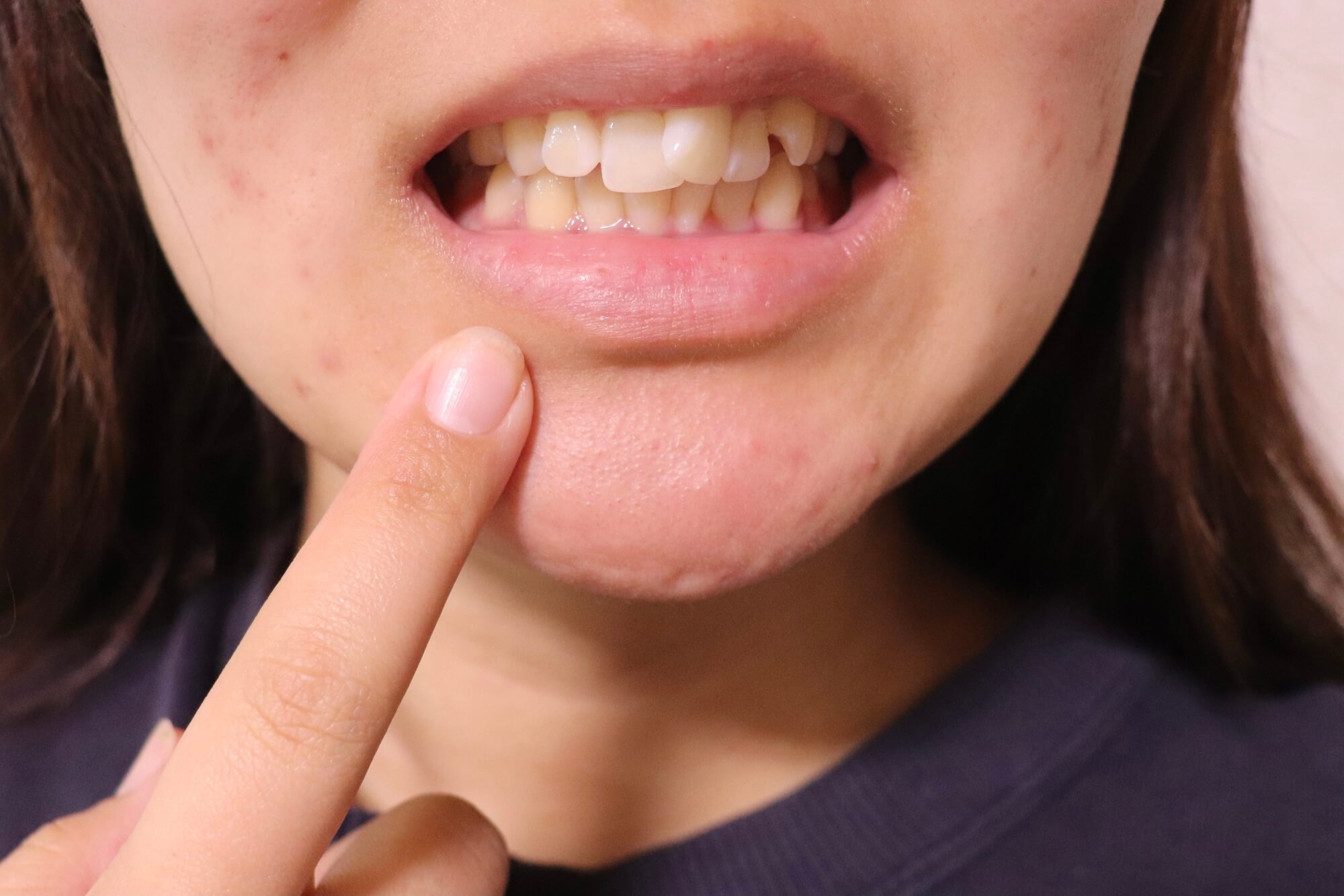 マウスピース矯正で出っ歯は改善できる！出っ歯を放置するリスクとは？